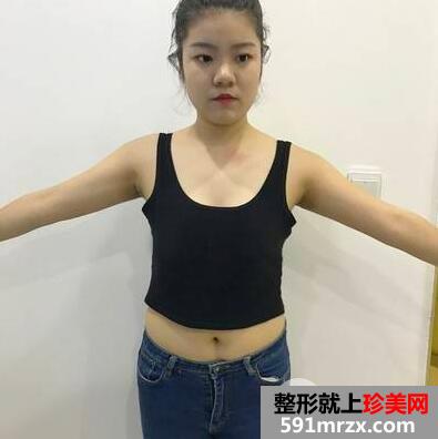自己脂肪隆胸手术真实案例|自体脂肪隆胸前后对比图