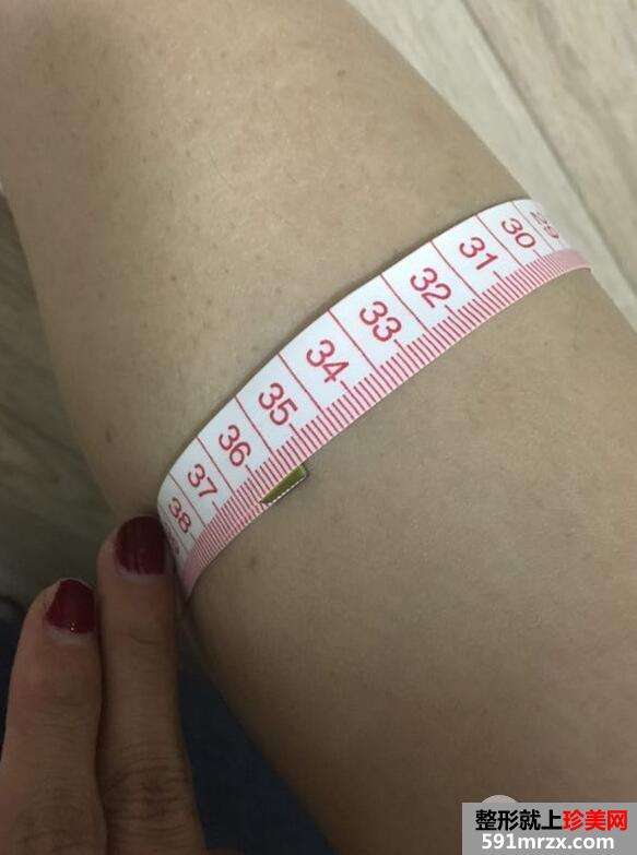 瘦腿针有效吗|注射瘦腿针真实案例