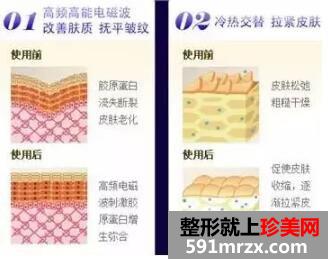 热玛吉除皱的价格是多少钱？附案例效果前后对比图分享~