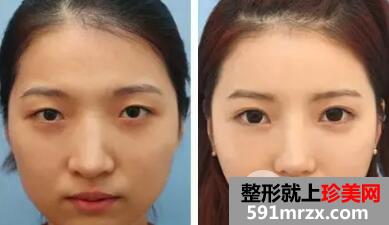 详解:韩式无痕开眼角手术,附案例效果对比图片恢复过程分享