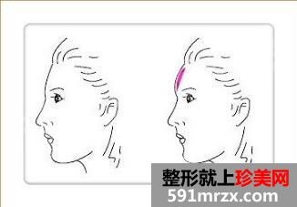 福州爱美尔整形医院隆额头脂肪填充案例效果图片分享~
