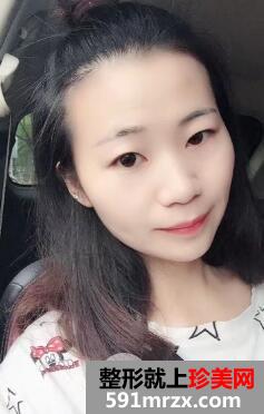 呼和浩特闫小林双眼皮整形案例图片美美的日记分享~