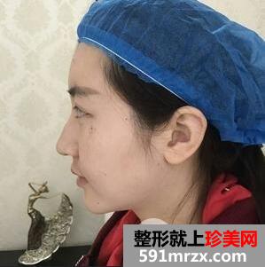 上海华美大咖李志海磨颧骨改脸型术后效果图分享，附上该院整形价