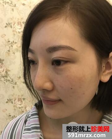 自体脂肪填充面部术后效果图分享，附上成都玉之光整形价格详情~