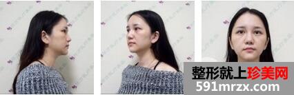 微创面部提升价格_案例分享，另附广州昂方整形医院价格详情
