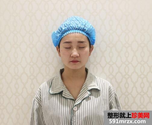 打瘦脸针前后效果图对比恢复过程图片分享