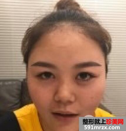 鼻综合价格大概多少？|假体+耳软骨+短鼻延长效果图