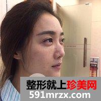 鼻综合三个月效果一览，堪比美图美出天际