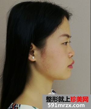 不再为塌鼻子烦恼，鼻部整形矫正多少钱？