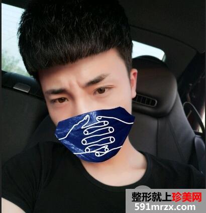 帅小伙去除眉间皱纹效果分享，瞬间年轻至少五岁