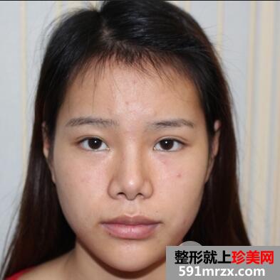 武汉韩式无痕开眼角多少钱，最新效果最低优惠效果不打折