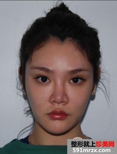 北京丽都美容医院假体隆鼻失败修复效果分享