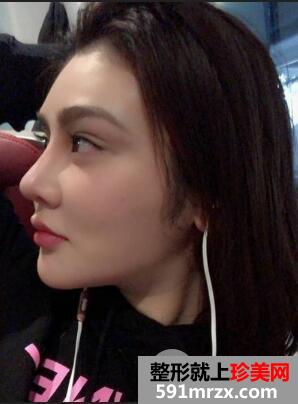 北京丽都美容医院假体隆鼻失败修复效果分享