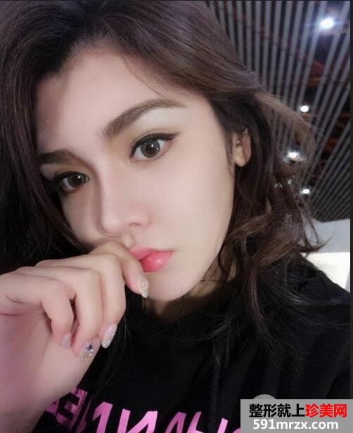 北京丽都美容医院假体隆鼻失败修复效果分享
