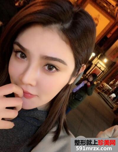 北京丽都美容医院假体隆鼻失败修复效果分享