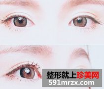 双眼皮失败的表现