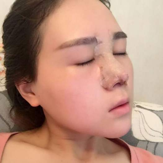 做自體肋軟骨和膨體綜合隆鼻后感受