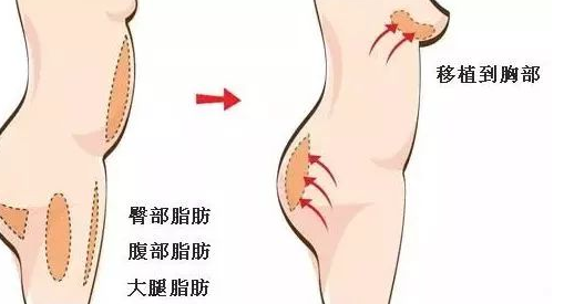 自体填充需要多少钱