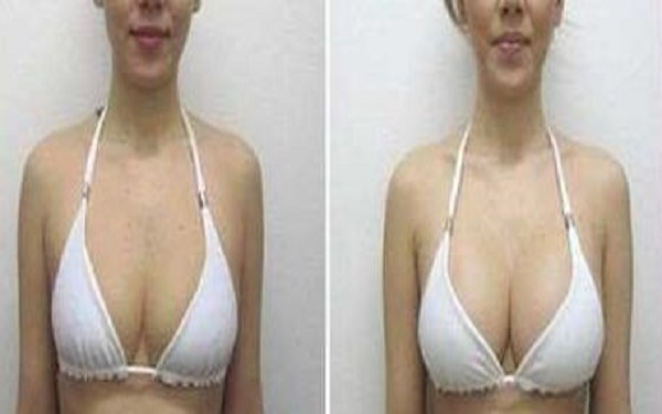 假体丰胸优点