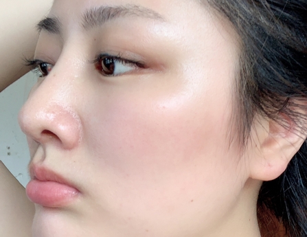 鼻梁可以打脂肪填充吗