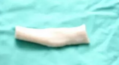 人工骨和异体骨的优缺点