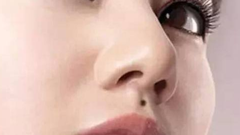鼻翼缩小的手术过程