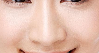 驼峰鼻如何矫正