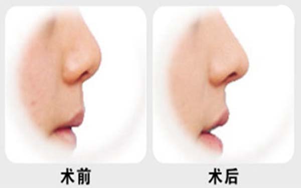 玻尿酸垫鼻基底多少钱