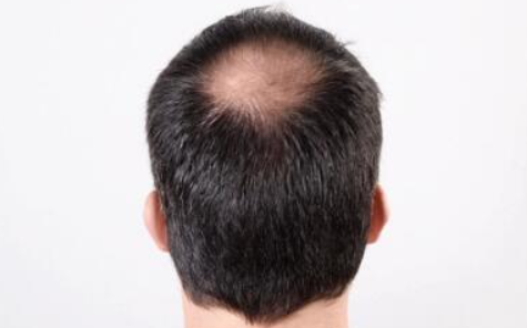掉头发应该怎么改善