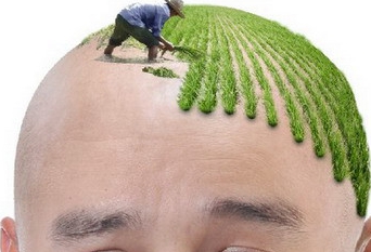 植发可以植长发吗