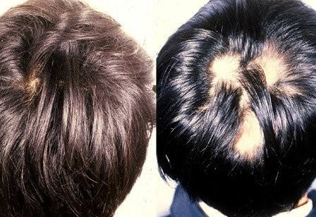 男性种植头发多少钱
