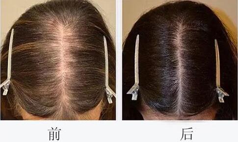 fut植发可以永久保持吗