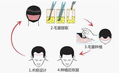 无痕植发要几次
