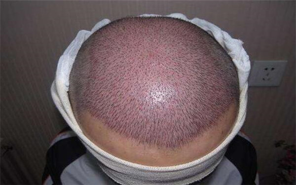 秃顶植发怎么样