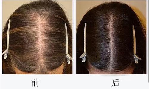 自体头发移植价格