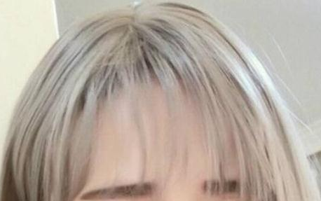 自体毛发移植哪里好