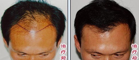 自体毛发移植的原理