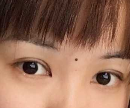 埋线抽脂了可以拆掉吗