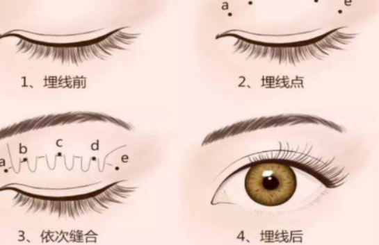 埋线双眼皮恢复了还能拆吗