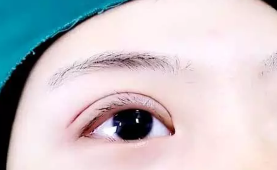 双眼皮割完太深了 有什么办法