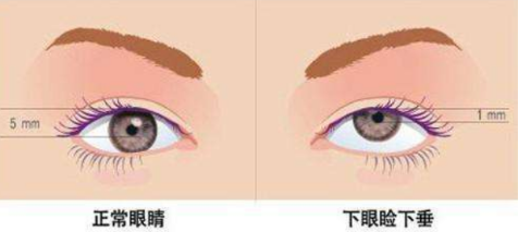 双眼皮有点下垂怎么办