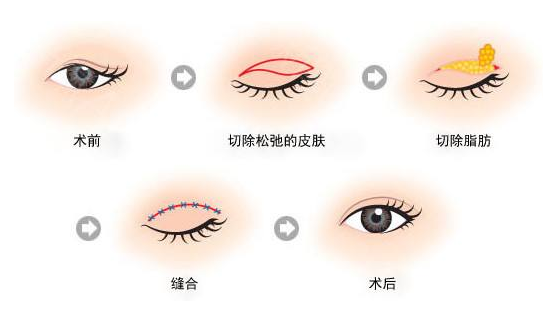 怎么做双眼皮好