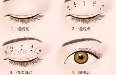 双眼皮埋线有什么危害