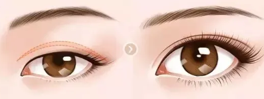 双眼皮是怎么割的