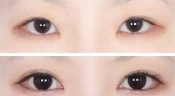 整眼要花多少钱？