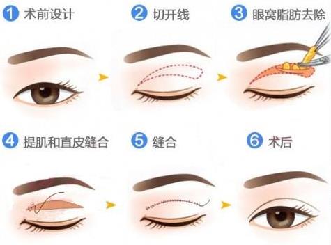 整双眼皮要多少钱