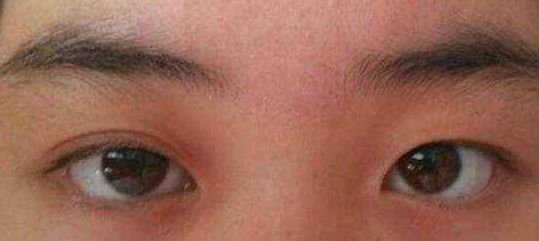 眼睛一大一小怎么矫正