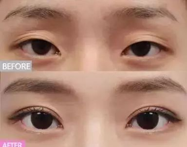 双眼皮松弛了怎么办