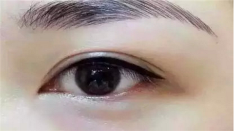 做开眼角好吗