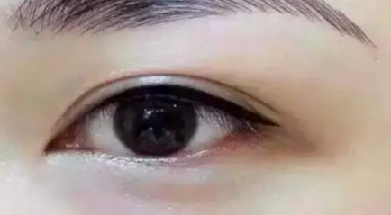 深圳双眼皮整形多少钱